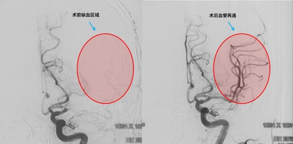 永旺配资 90岁老人地铁突发脑梗，四一一医院多学科联手战胜死神